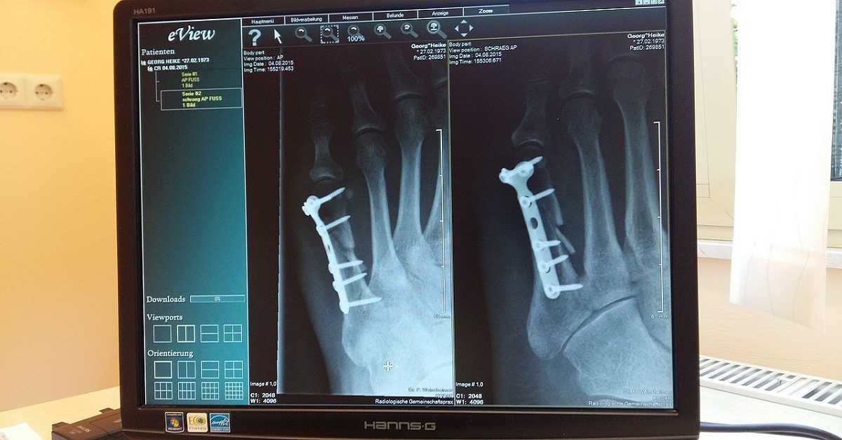 a x-ray of fractured bone